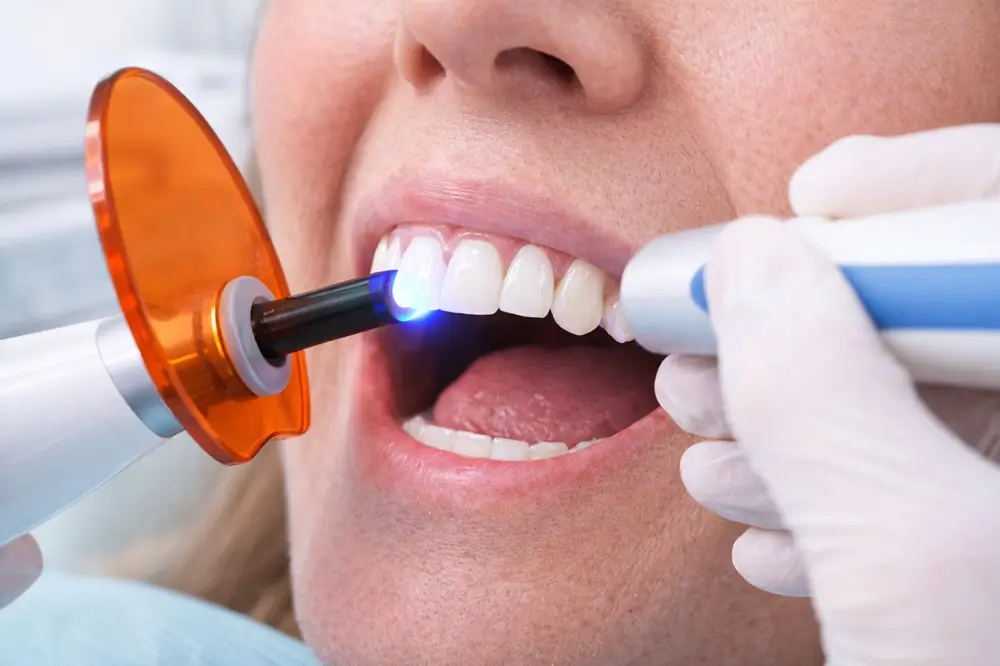 Porcelain Veneers